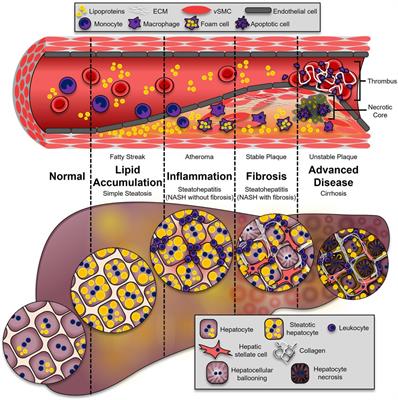 The interplay between nonalcoholic fatty liver disease and atherosclerotic cardiovascular disease